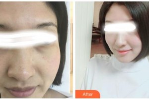 吉林吉化集團(tuán)總醫(yī)院燒傷整形科劉鳳彬整形價(jià)格表附美白嫩膚案例展示