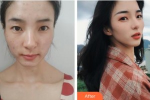 吉林大學(xué)第一醫(yī)院整形美容科彭維海整形價(jià)格表附激光祛斑案例展示