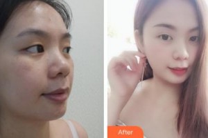 吉林大學(xué)第一醫(yī)院整形美容科張舵整形價(jià)格表附無針?biāo)獍咐故?>
</a>
<h3 class=