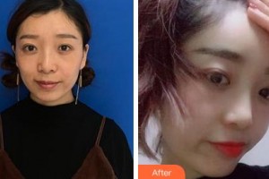 吉林瑞澳醫(yī)學美容醫(yī)院張建亮整形價格表附玻尿酸精華導入案例展示