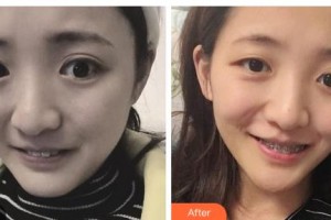 吉林銘醫(yī)整形美容醫(yī)院詹柏華整形價格表附金屬托槽矯正案例展示