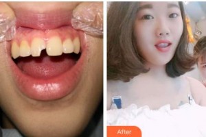 吉林中妍整形美容醫(yī)院姜雪整形價格表附美白貼片案例展示