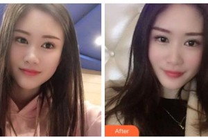 吉林星范醫(yī)療美容門診部楊雯淇整形價格表附冷光美白案例展示