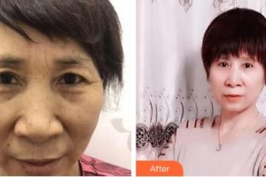 吉林市中心醫(yī)院燒傷整形外科宋博住院醫(yī)師整形價格表附切眉術案例展示