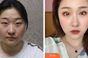 吉林市中心醫(yī)院燒傷整形外科樸俊宇整形價格表附眼部綜合案例展示