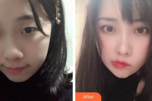 吉林大學中日聯誼醫(yī)院燒傷整形外科林駐煥整形價格表附眼部綜合案例展示