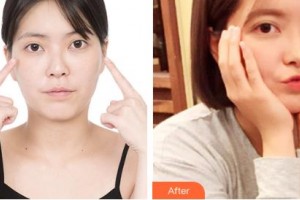 吉林市中心醫(yī)院燒傷整形外科王大壯整形價格表附開內眼角案例展示