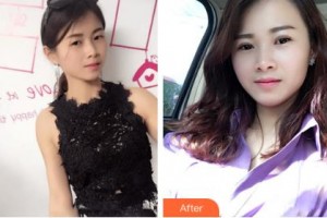 吉林大學中日聯誼醫(yī)院燒傷整形外科王之清整形價格表附切開雙眼皮案例展示