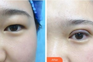 吉林市中心醫(yī)院燒傷整形外科林貞姬整形價格表附眼部綜合案例展示