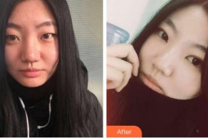 吉林市中心醫(yī)院燒傷整形外科張雪峰整形價格表附埋線雙眼皮案例展示