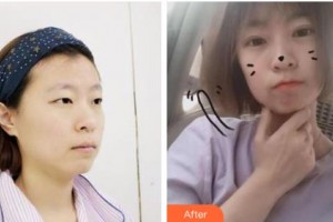 長春韓一美容醫(yī)院李鐘奇整形價格表附切開雙眼皮案例展示