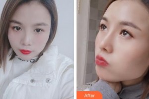 長春正韓醫(yī)療美容醫(yī)院張志雪整形價格表附肋軟骨隆鼻案例展示