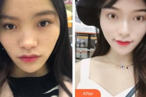 長春韓一美容醫(yī)院金鐘皖整形價格表附耳軟骨復(fù)合隆鼻案例展示