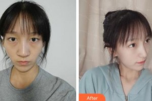 長春海峽美容醫(yī)院孟憲勇整形價格表附耳軟骨復(fù)合隆鼻案例展示