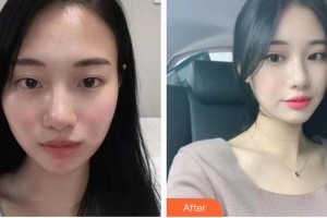 長春秀爾醫(yī)療美容診所樸永男整形價格表附眼部修復(fù)案例展示