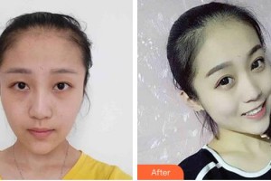 長春西之米醫(yī)療美容醫(yī)院李志成整形價格表附外切祛眼袋案例展示