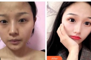 長春圣華抗衰老醫(yī)學(xué)研究院崔林整形價格表附激光去眼袋案例展示