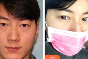 長春宮麗娟醫(yī)療美容診所宮麗娟整形價格表附定點雙眼皮案例展示