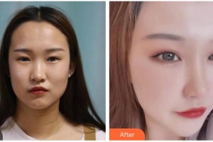 長春圣華抗衰老醫(yī)學(xué)研究院池岳龍整形價格表附眼部綜合案例展示