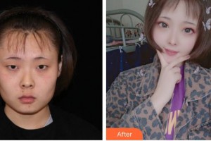 長春華璦美容醫(yī)院龔春靜整形價(jià)格表附眼部綜合案例展示