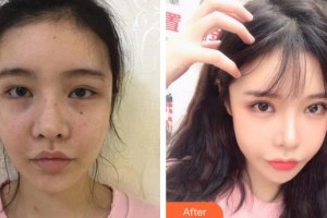 長春韓合愛心美容醫(yī)院孫琦整形價格表附眼部綜合案例展示