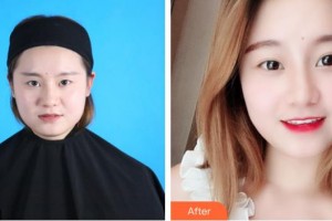 長春華璦美容醫(yī)院楊冰楠整形價格表附切開雙眼皮案例展示