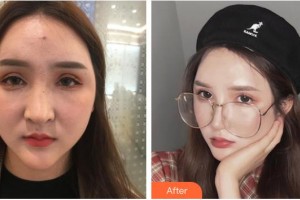 長春奧拉克美容醫(yī)院陳繼革整形價格表附手術(shù)縮鼻頭案例展示