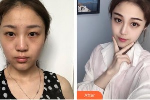 長春奧拉克美容醫(yī)院李相信整形價格表附硅膠隆鼻案例展示