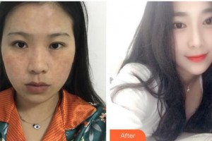 長春中妍醫(yī)療美容醫(yī)院王洋整形價格表附激光祛斑案例展示