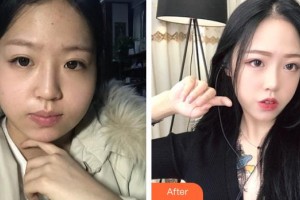 長春奧拉克美容醫(yī)院安淅鏞整形價(jià)格表附光子嫩膚案例展示