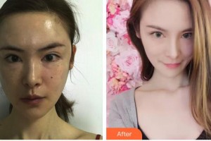 長春中妍醫(yī)療美容醫(yī)院李沖住院醫(yī)師整形價格表附玻尿酸精華導(dǎo)入案例展示