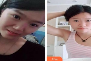 長春美奇醫(yī)療美容外科門診部張鵬飛整形價(jià)格表附埋線提升案例展示