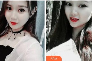 長春拜博口腔醫(yī)院周文整形價格表附牙齒隱形矯正案例展示