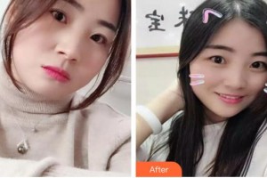 長春奧拉克美容醫(yī)院侯克整形價格表附埋線提升案例展示