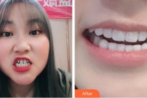 長春欣雅口腔門診部樸月梅住院醫(yī)師整形價格表附牙貼面案例展示