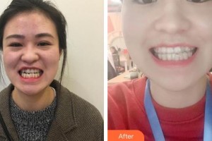 長春詩邁爾口腔門診部朱峰整形價格表附牙齒隱形矯正案例展示