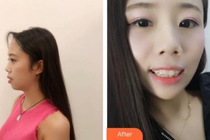四平市中心醫(yī)院整形美容科張聰整形價(jià)格表附牙齒隱形矯正案例展示