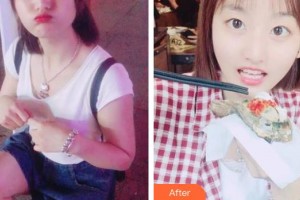 四平市燒傷整形醫(yī)院衛(wèi)長榮整形價(jià)格表附美白劑美白牙齒案例展示