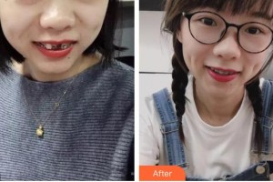 四平王清純醫(yī)療美容診所王清純整形價格表附金屬托槽矯正案例展示