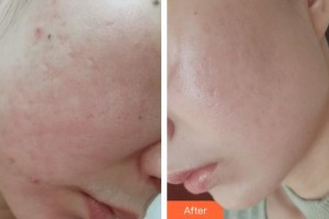 四平王清純醫(yī)療美容診所王秀純整形價格表附去痘印痘坑案例展示