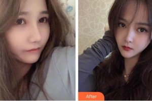 四平市中心醫(yī)院整形美容科馬群整形價格表附清潔祛痘案例展示