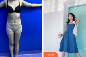 新疆千禧麗人整形美容醫(yī)院趙靖整形價格表附大腿吸脂案例展示