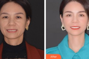 大慶康美口腔門診部王良敏整形價格表附牙齒矯正案例展示