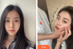 佳木斯伊美醫(yī)學(xué)整形外科診所陳成整形價格表附眼部手術(shù)案例展示