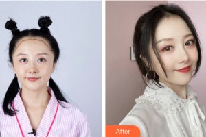 新疆威茲曼整形外科醫(yī)院余艷輝整形價(jià)格表附植發(fā)案例展示