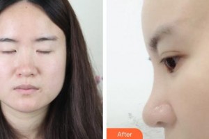 松原齊飛美容外科門(mén)診部杜彥超整形價(jià)格表附耳軟骨復(fù)合隆鼻案例展示