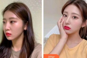 松原齊飛美容外科門(mén)診部周春玲整形價(jià)格表附鼻部綜合案例展示