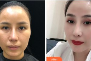 陜西省人民醫(yī)院燒傷整形醫(yī)學(xué)美容科鐘德才整形價格表附熱拉提案例展示