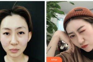 陜西省人民醫(yī)院燒傷整形醫(yī)學美容科康淑檀整形價格表附埋線提升案例展示