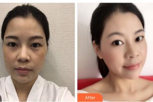 陜西華西醫(yī)院西美整形美容中心唐彩霞整形價格表附埋線提升案例展示